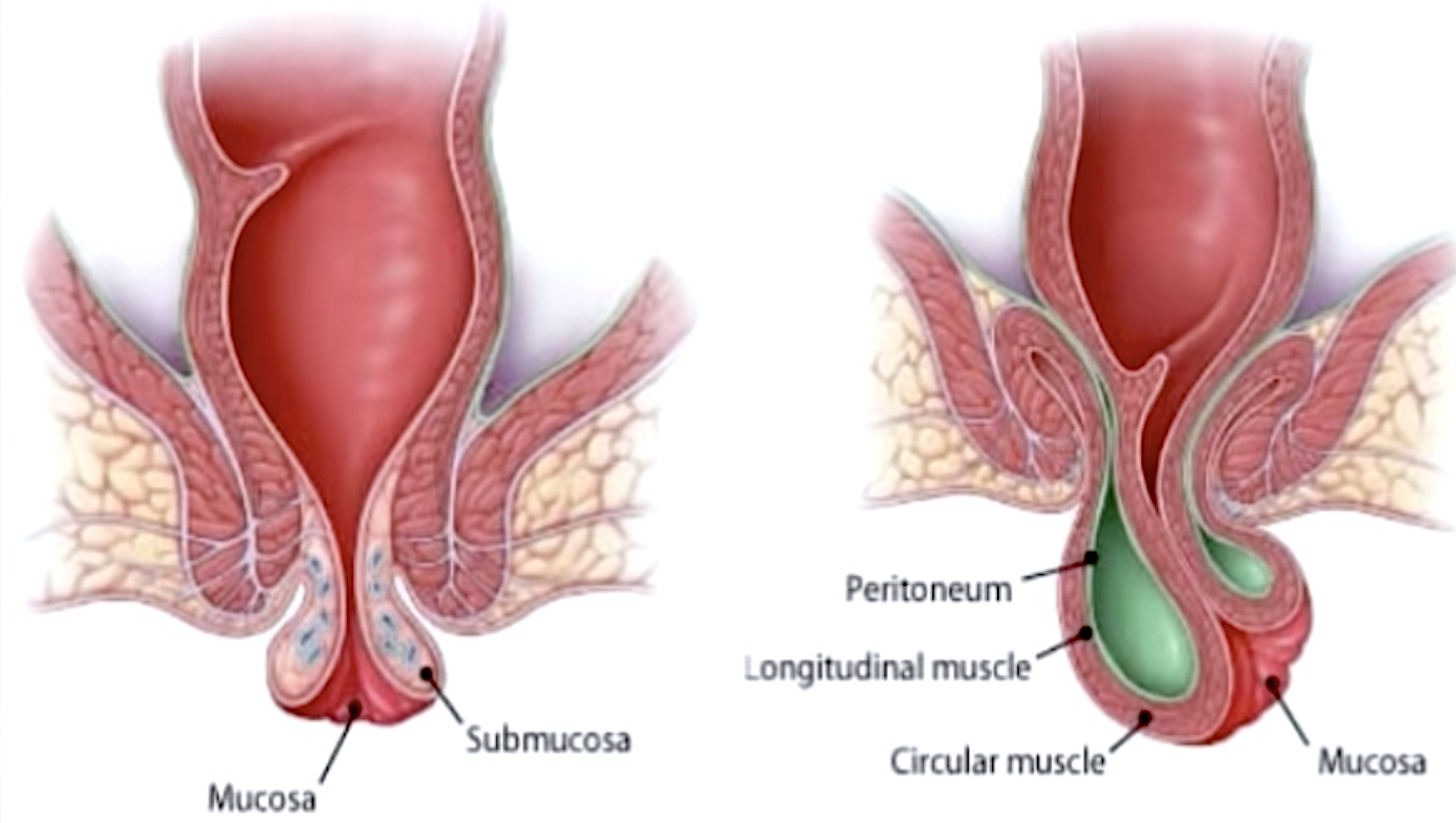 Mucosal Prolapse vs. Full Rectal Prolapse in a Dog